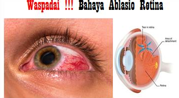 Asuhan Keperawatan Dan Biaya Operasi Penyakit Ablasio Retina ( Retina Mata Lepas ) Di Rumah Sakit