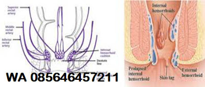Agar Wasir Cepat Membaik, Harus Bagaimana?