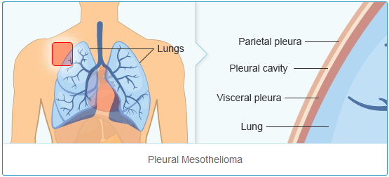 Pleural Mesothelioma