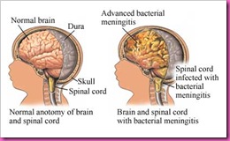 meningitis