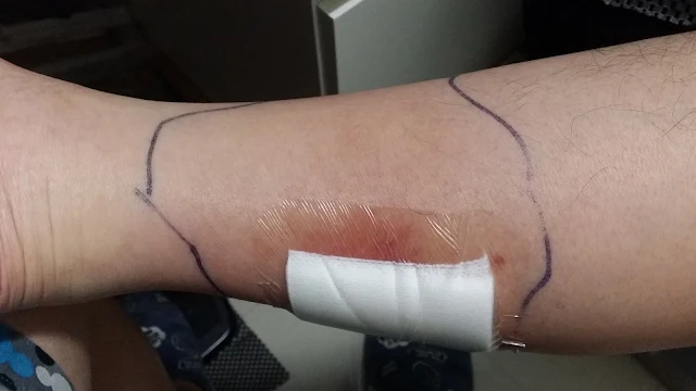 A large piece of tape over the Cellulitis wound