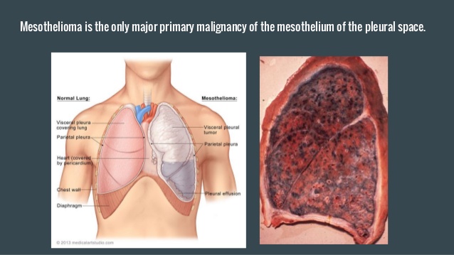 Mesothelioma-meaning