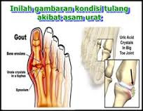 obat asam urat dokter