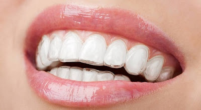 Niềng răng xong có phải đeo hàm duy trì không? 