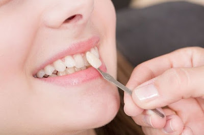 Bọc răng sứ khi bị móm hiệu quả khi nào? 2