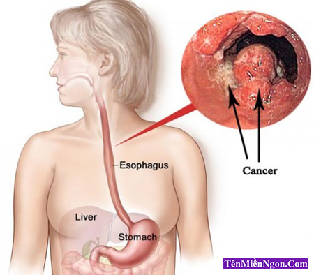 Những hiểu lầm về Ung thư Thực quản