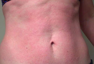  Skin rashes all over the patient's trunk pics