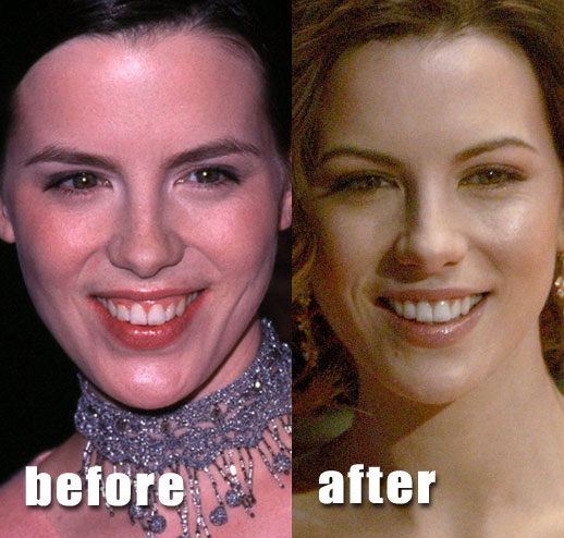 megan fox plastic surgery before and after pics. megan fox plastic surgery