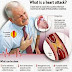 HEART ATTACK NATURAL REMEDY (myocardial infarction)