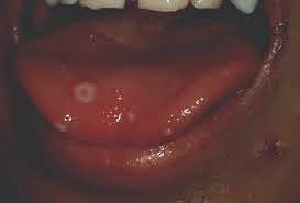 varicela vezicule limba