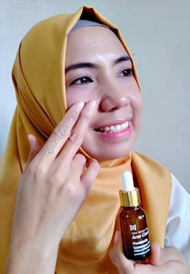 Obat jerawat batu