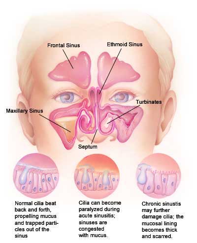 Sinusitis