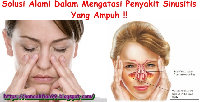 Obat Sinusitis Tradisional Paling Mujarab