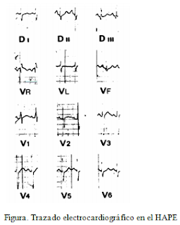 Electrocardiographic tracing in HAPE