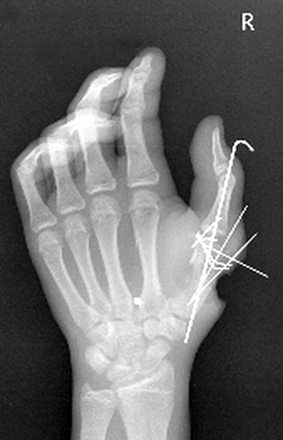 Thumb fractures | Fractured Thumb Treatment