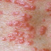 Obat Gatal untuk bintil bintil merah pada kulit