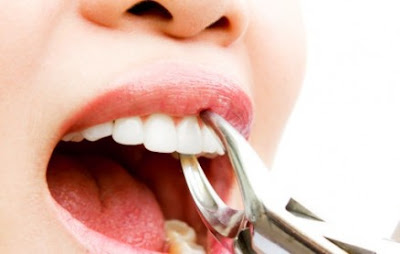 Sau nhổ răng bao lâu thì trồng răng giả là được?-1