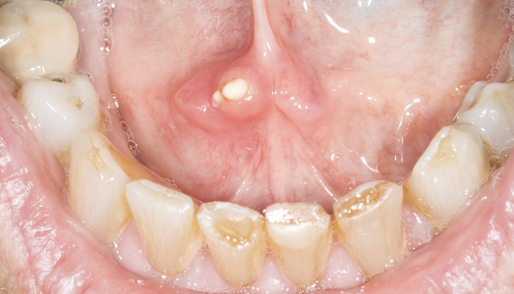 حصيات الغدد اللعابية Salivary gland stones