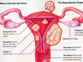 Fibroid Dah Mengecut Dari 7 cm Ke 3 cm