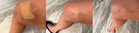 Points de suture