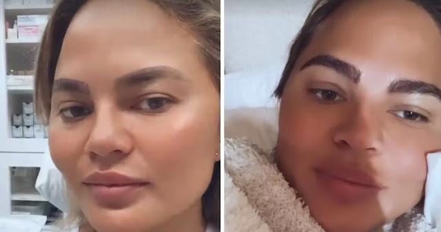 Chrissy Teigen prima e dopo il trapianto sopracciglia