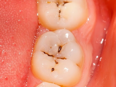 Răng đau nhức khi nhai là biểu hiện của bệnh gì? 2