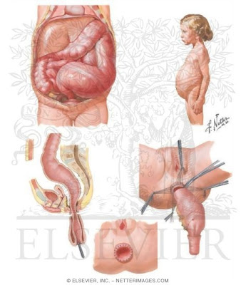 Masalah Sembelit (Constipation) ~ seribupilihan