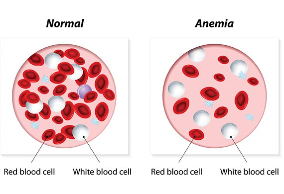 normal blood cell VS anemia blood cell
