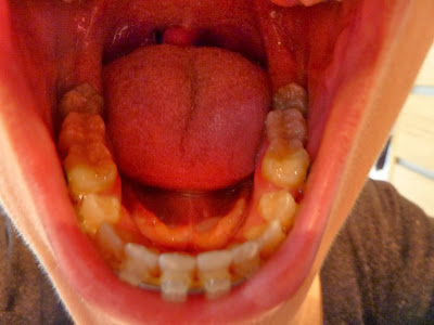 A photo of my teeth 34 weeks into orthodontic treatment