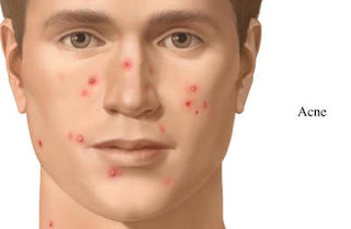 Prescription acne medication for oily skin