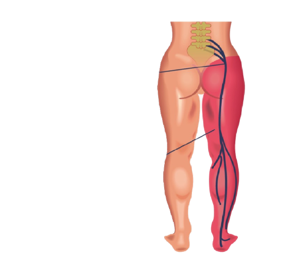 Back pain & Sciatica (Dont)