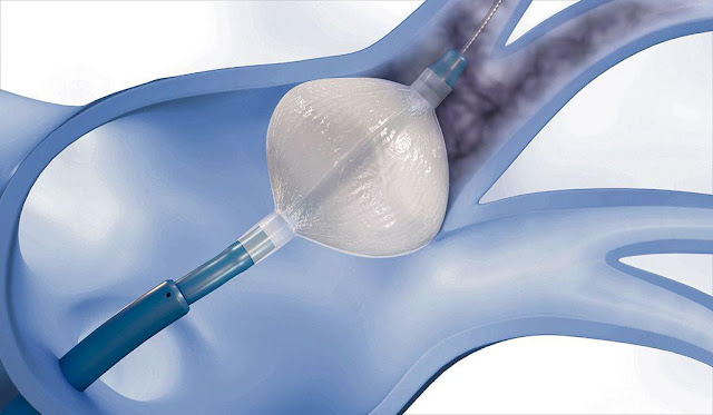 Cryoablation Devices