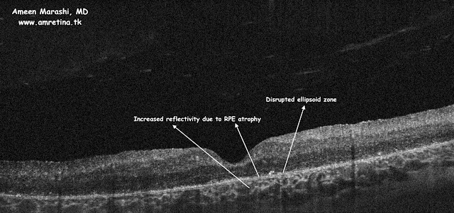 OCT cross-section showing RPE atrophy with ellipsoid zone disruption in cone-rod dystrophy