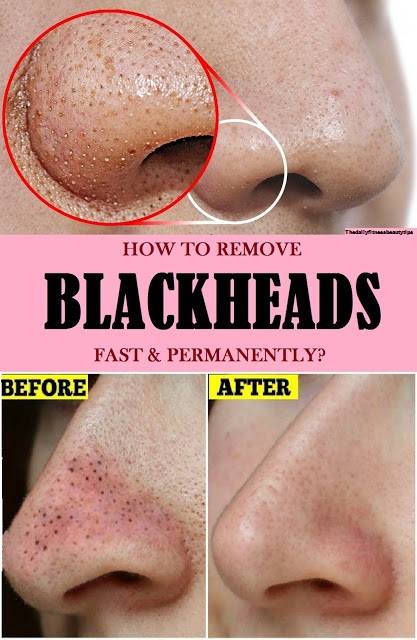 blackheads-treatment