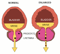 Puji syukur senantiasa penulis panjatkan ke hadirat Allah SWT Karen dengan rahmatnya penul CONTOH MAKALAH Benigne Prostat Hyperplasia (BPH)