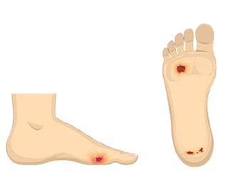 Diabetes wounds on the feet treated with bacteriophages