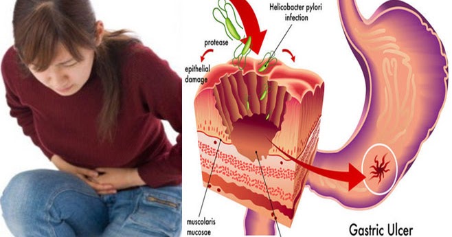 Bagaimana Cara Menghindari Penyakit Gastritis dan GERD ...