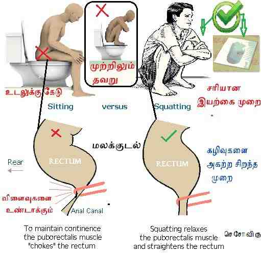 மலம் கழிக்கும் முறை - Western Toilet Vs Indian Toilet