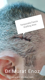 Temporalis Fascia Grafting