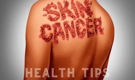 Skin Cancer: Symptoms, Causes and Treatment