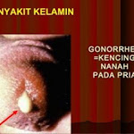 Penyebab Keluar Nanah Dari Kemaluan Pria