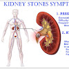 Kidney Stones Symptoms