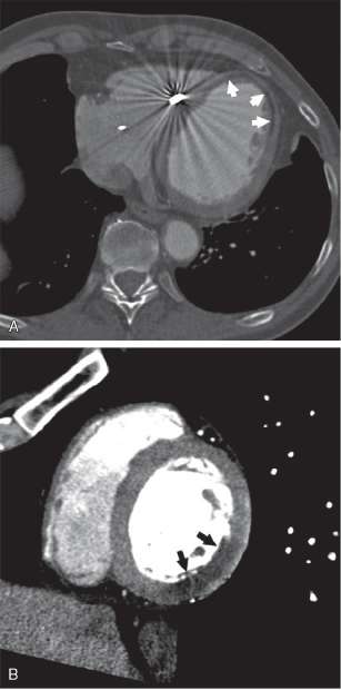 aneurysm definition. aneurysms and aneurysms of