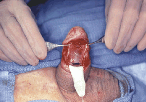 Penile Implants for Erectile Dysfunction
