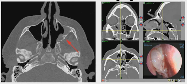 inverted-papilloma-CT