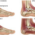 Physiotherapy dan rawatan Ankle Sprain