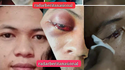 DIREKTUR RSUD CABANG BUNGIN AKAN KELUARKAN PERS RELEASE PASIEN BUTA PERMANEN 