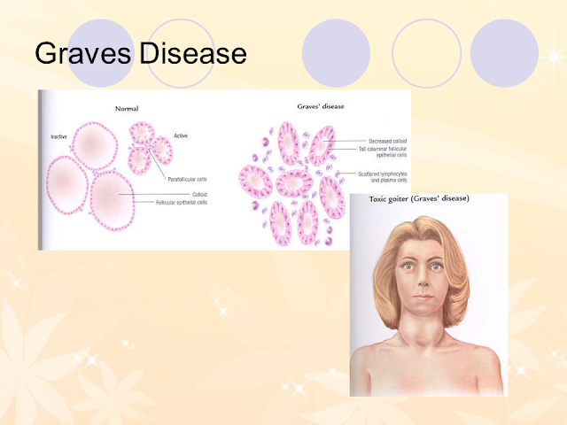 Graves Disease