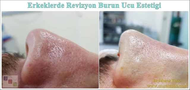 Revizyon burun ucu estetiği ameliyatı - Revizyon burun ucu estetiği operasyonu - Revizyon burun ucu ameliyatı fotoğrafları - Revizyon tipplasti operasyonu fotoğrafları