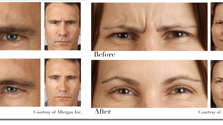 Botulinum Toxin - Botox Medicine